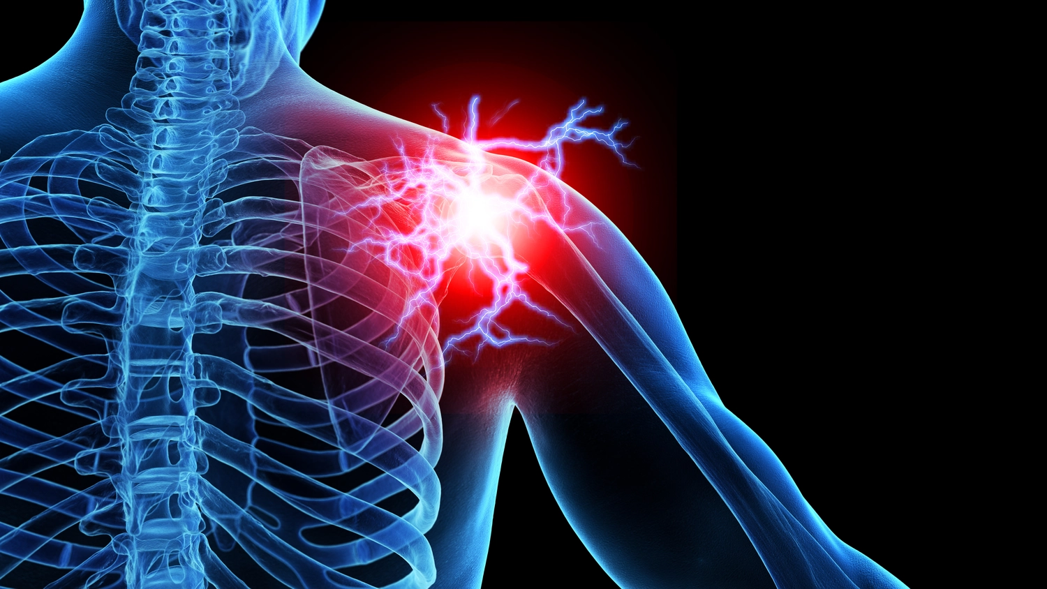 Dr. Tareq Soumma Cum Laude - Orthopäde für Hüfte - 3D-medizinische Illustration von Schulterschmerzen